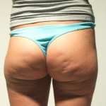 liposuctie