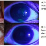 Droge ogen