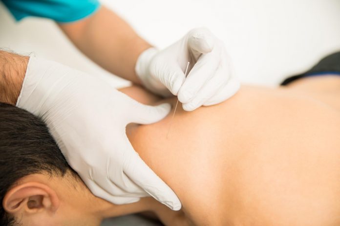 dry needling